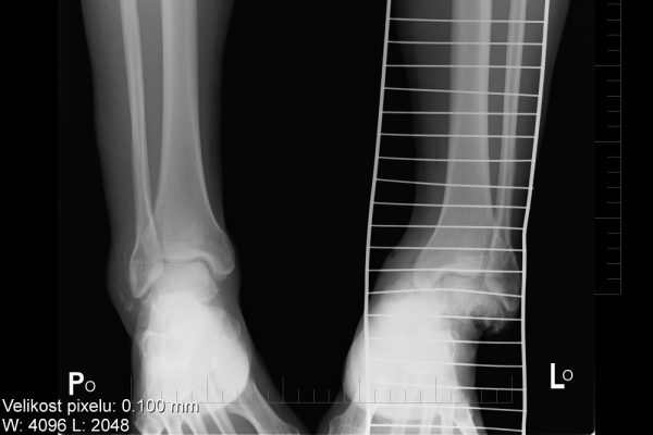 Moje kotníky po pádu ve Vysokých Tatrách